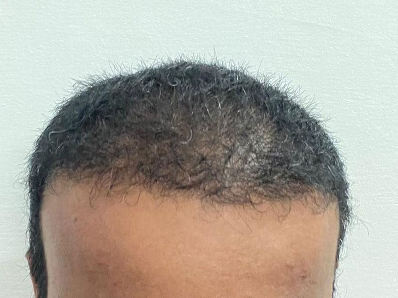 Hair transplant - After treatment