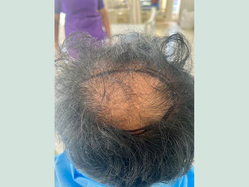 Hair transplant - Before treatment